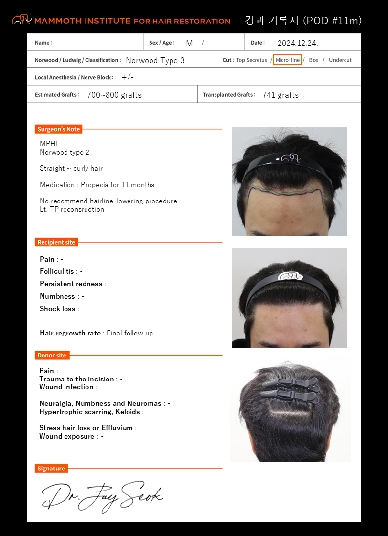 비절개 모발이식 1년 결과 후기. 여러모로 감사합니다.