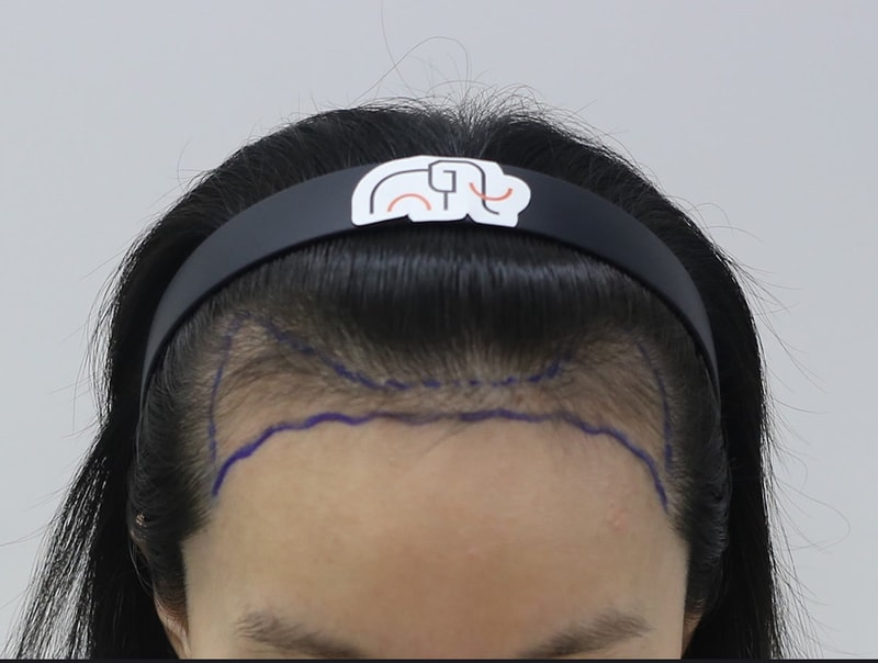 Apgujeong Mammoth Non-Cutting Hair Transplantation Director Nam Da-woo's final 10 months review