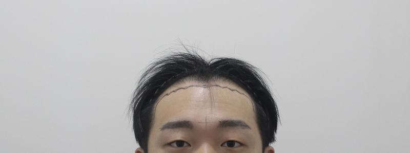 ★모프로의원★ 헤어라인 모발이식 비절개 4200모 14일 경과
