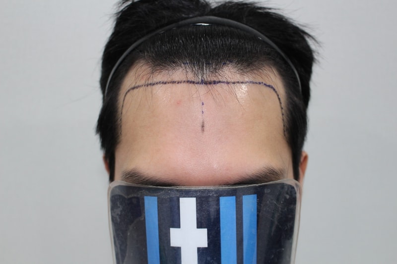 [모더함] M자라인 남성 비절개 수술 다음날 후기