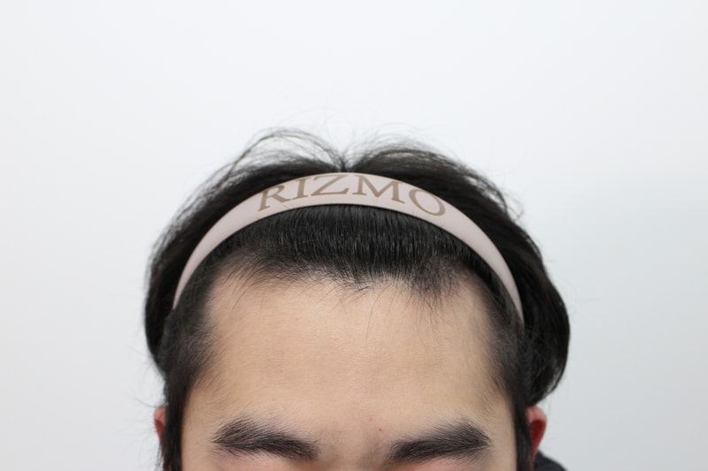 부산 리즈모의원 비절개 모발이식 2주차