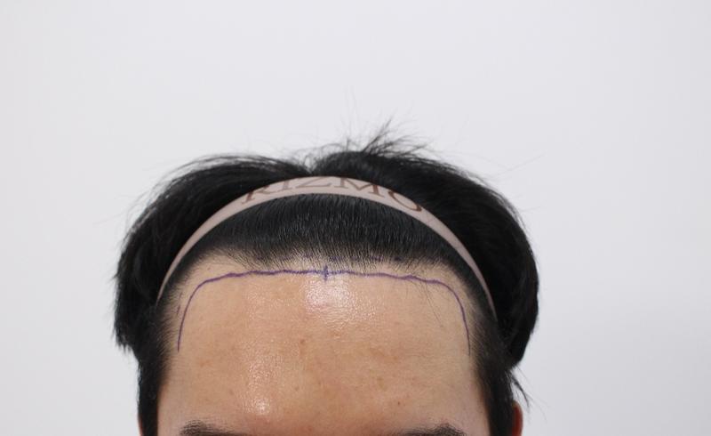 About 8 months of hair transplantation at Lizmo Clinic in Busan