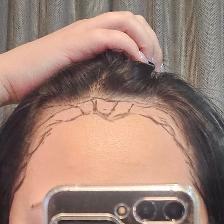 The review of the 13th day of the Hair Transplant of the Apgujeong Moeul Clinic
