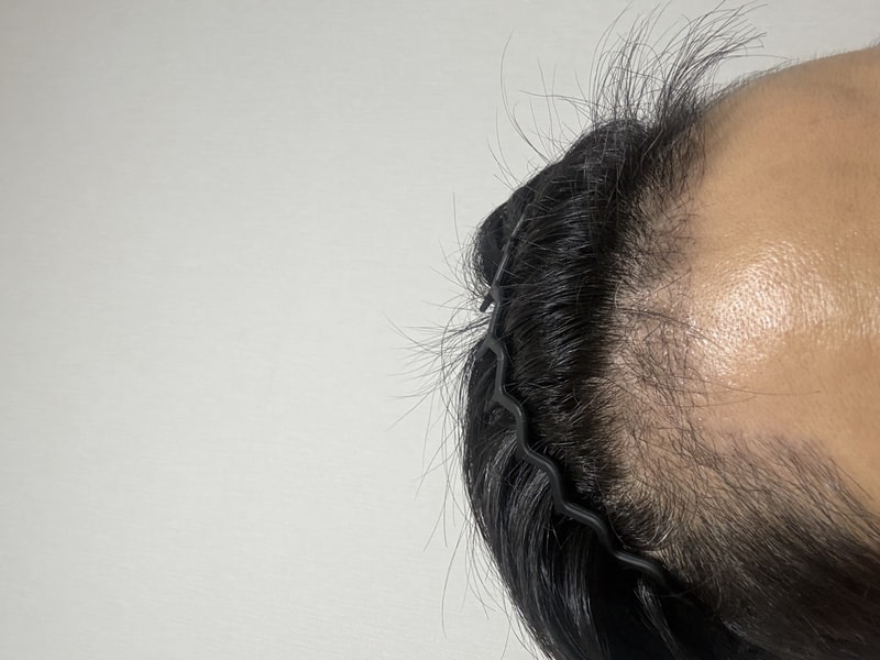 Daegu HAIRO HAIR TRANSPLANT CENTER Non-cut 3000 Mo 100th day