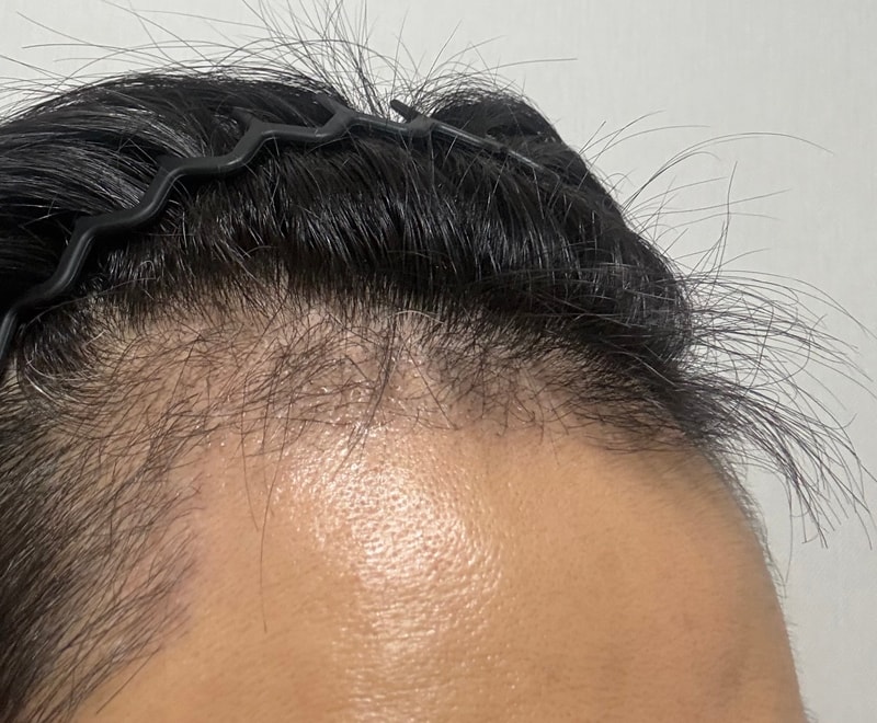 대구 헤어로 비절개 3000모 100일차