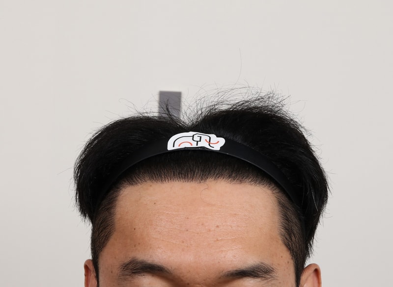Busan Hair Transplantation Slit Method Mammoth Wide Eyelma M-Shape 7 Months After