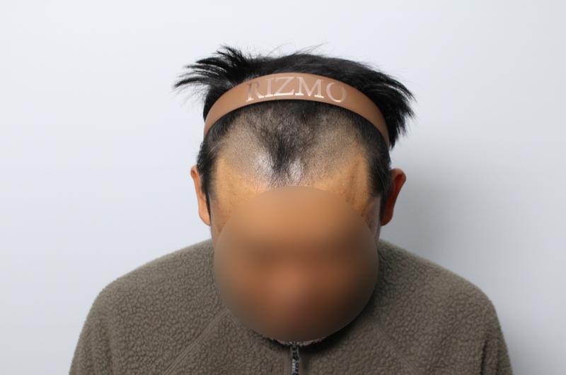 大田 リーズモ M字 ヘアライン 4400毛 毛髪移植 2週目 レビュー