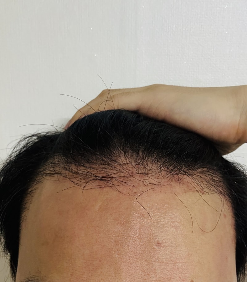 毛髪移植2ヶ月目
