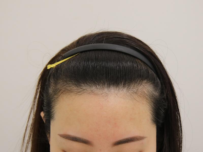It's been 4 months since the last hairline for a girl
