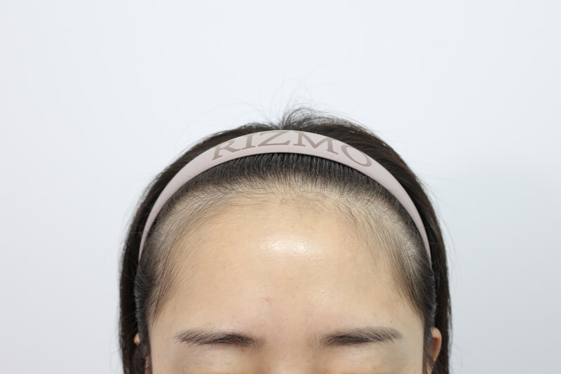 부산리즈모의원 모발이식 2주차경과