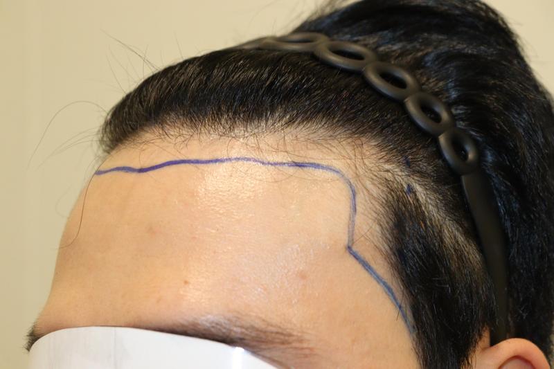 大邱ヘアロ医院2600床 2週目経過後のレビュー