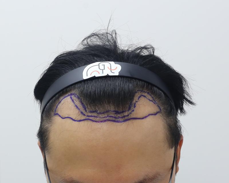 狎鴎亭マンモスヘアライン医院の毛髪移植4ヶ月のレビューです。