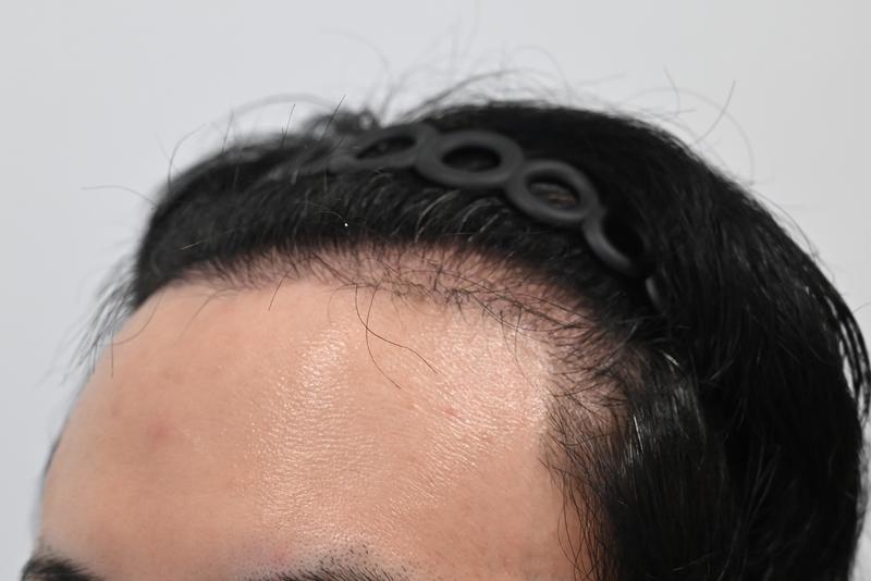 Hidden Cut 3 months later