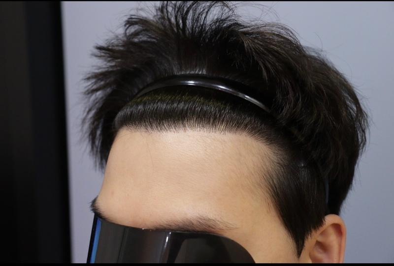 광주 압구정모비앙의원 1년 경과 후기