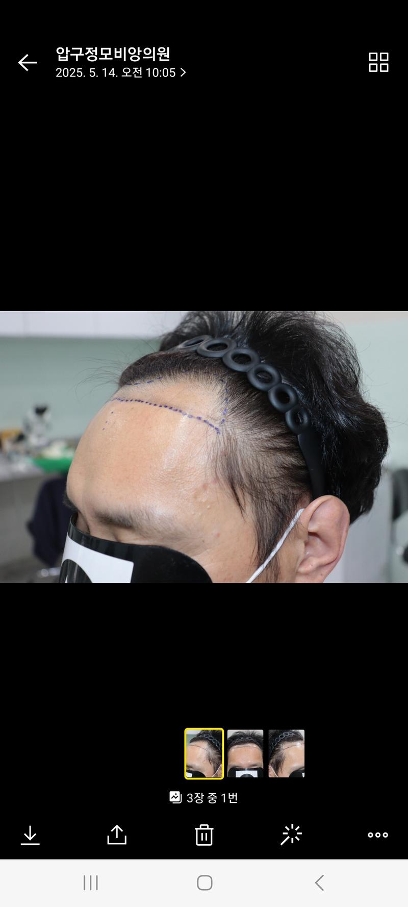 광주압구정모비앙의원 1년경과후기