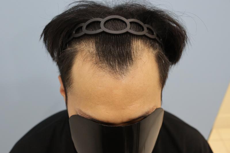 모발이식