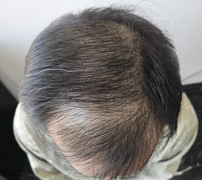 母材性非切開毛髪移植直後のレビュー