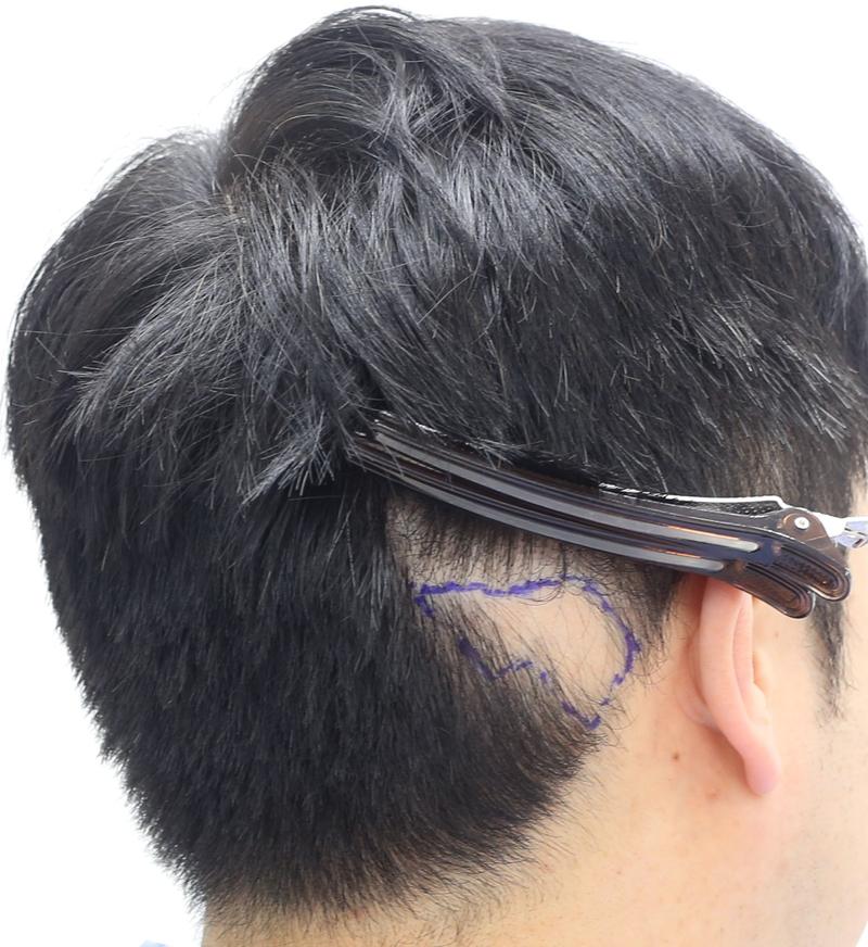Scars, circular hair loss, non-cut hair transplantation. It's late in 7 months [Apgujeong's mammoth Nam Dowoo]