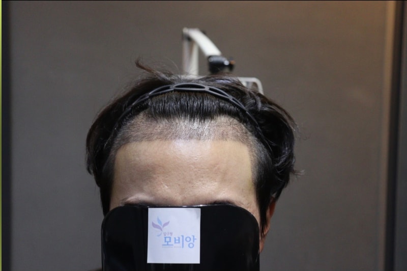 광주 압구정 모비앙의원 모발 의식 11일 경과 후기