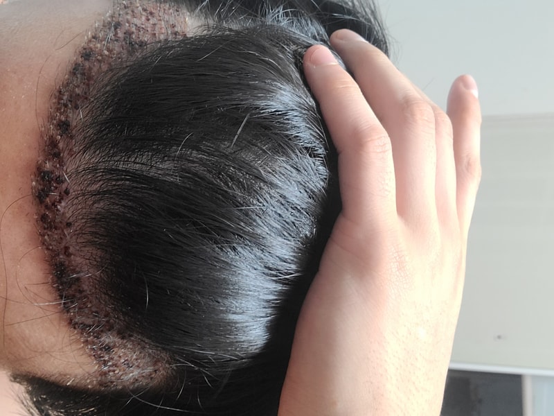 Day 6 of hair transplant