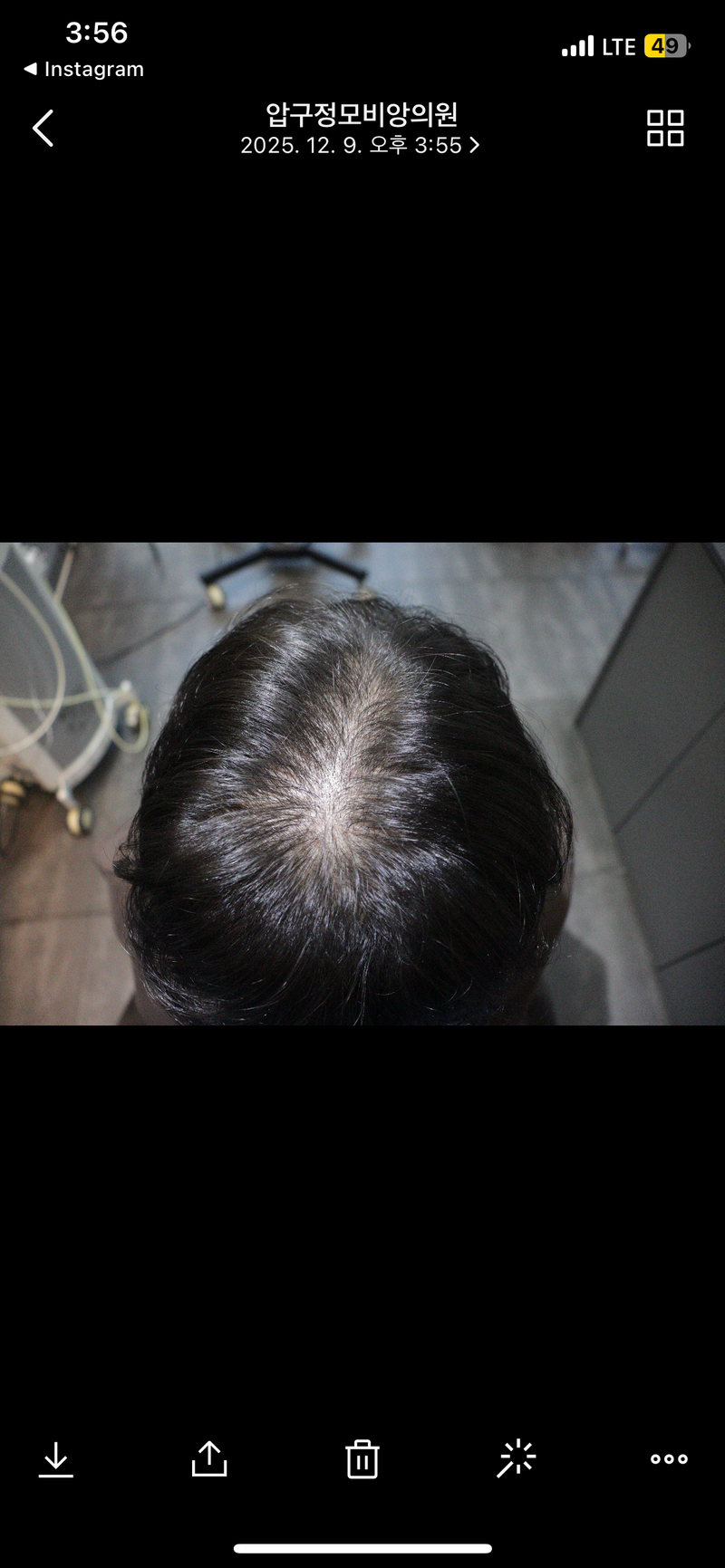 광주 압구정모비앙의원 모발이식 10일경과후기