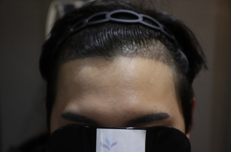 광주 압구정모비앙의원 모발이식 10일차 경과후기