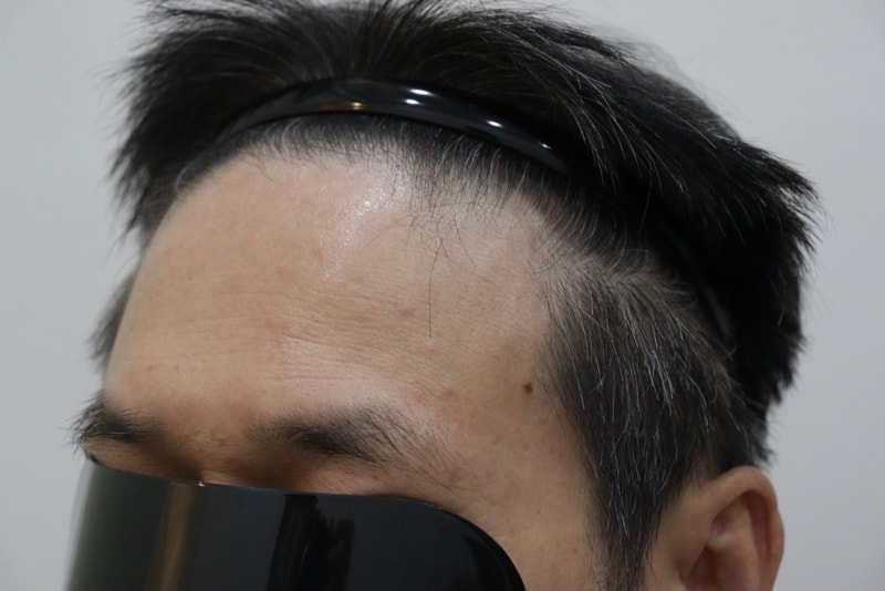 광주압구정모비앙의원 모발이식 10개월경과후기