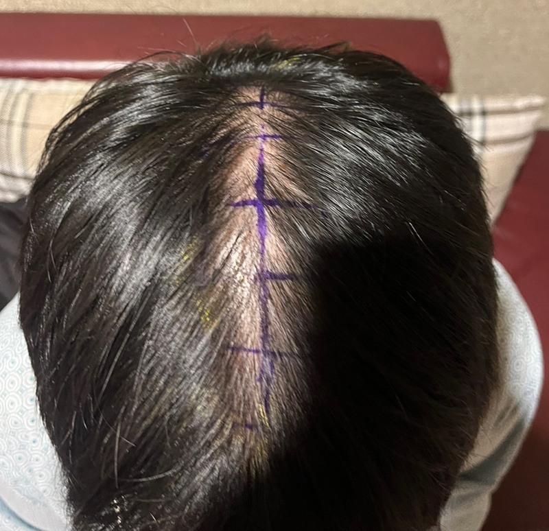 New hair / Non-cut hair transplant / 1500 hair follicles / 90th day late