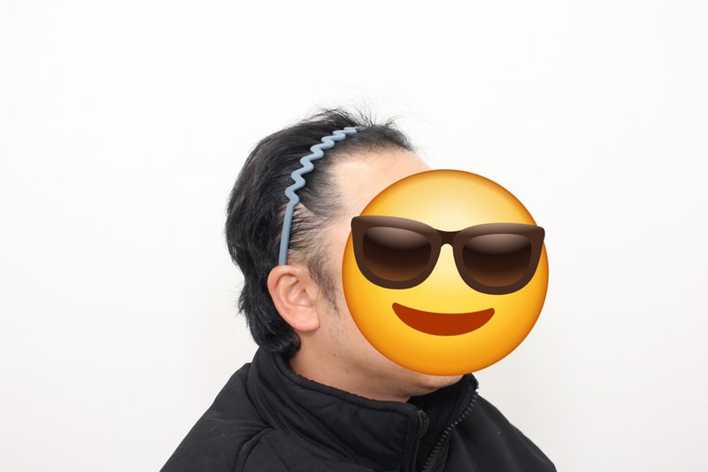 (모프로의원) 5109모 모발이식후기