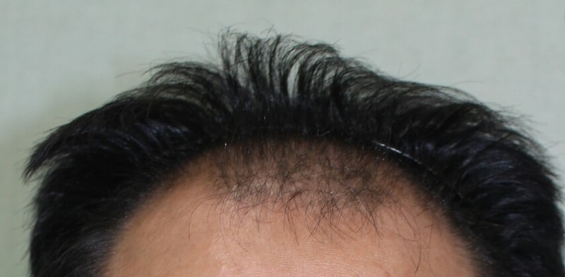 11 months after the incision (4,500 moles)