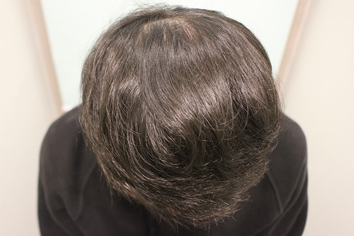 수술후 4개월.jpg