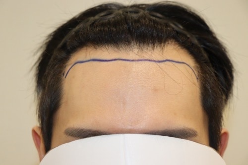 HAIRO HAIR TRANSPLANT CENTER Daegu Hair Transplant 2200 Mo 2nd week review