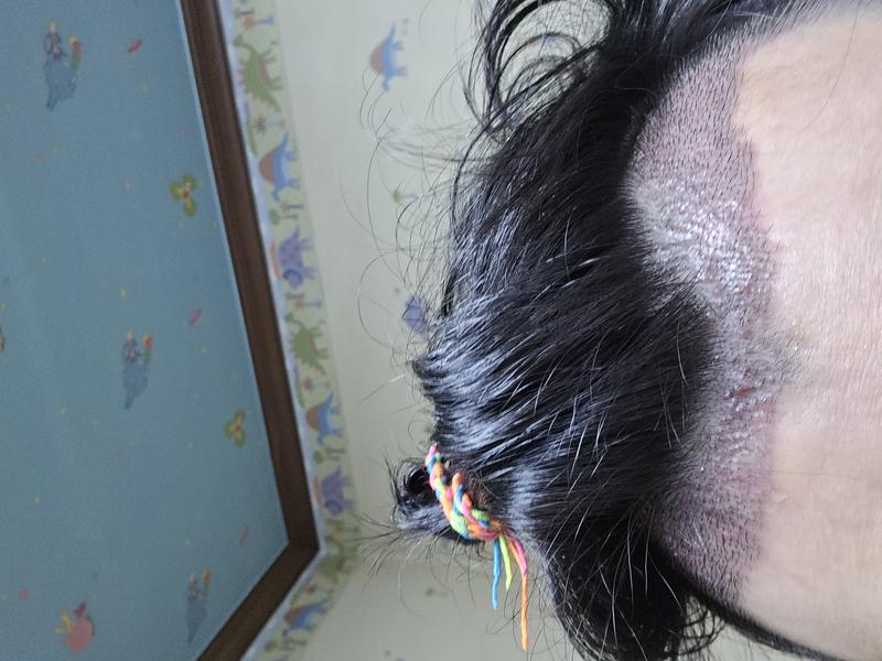 Day 10 and 19 of surgery photos