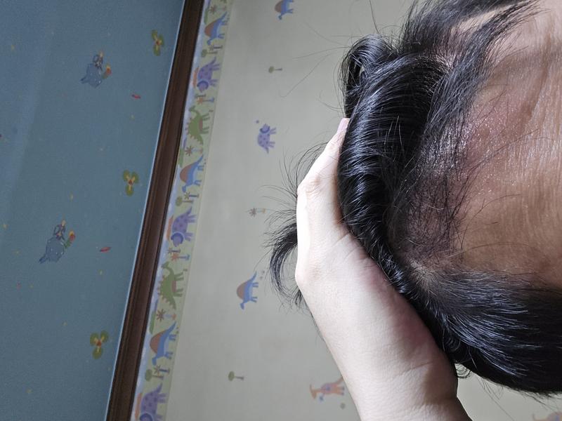I'm in the third month of a hair transplant