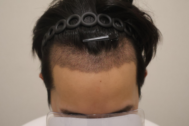ドンタンヘアで医院切開 3800本 10日経過後記
