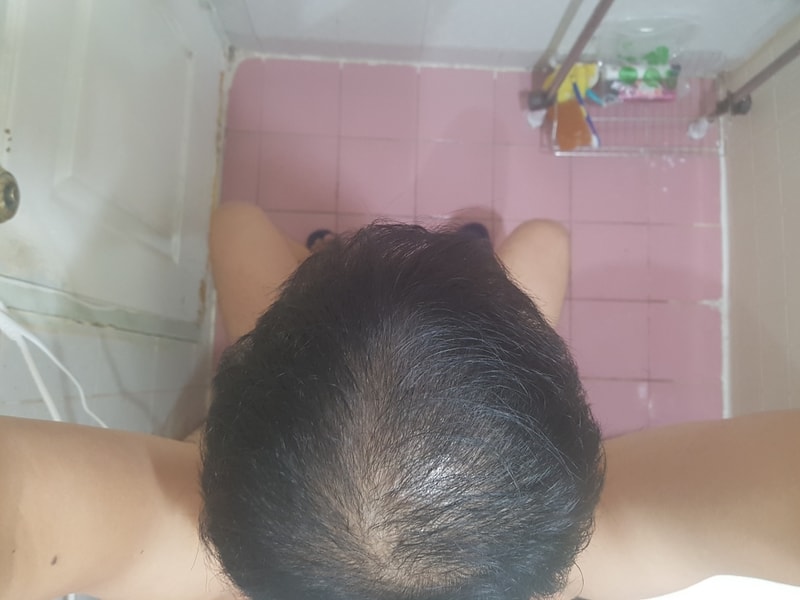 수술후-5개월후2.jpg