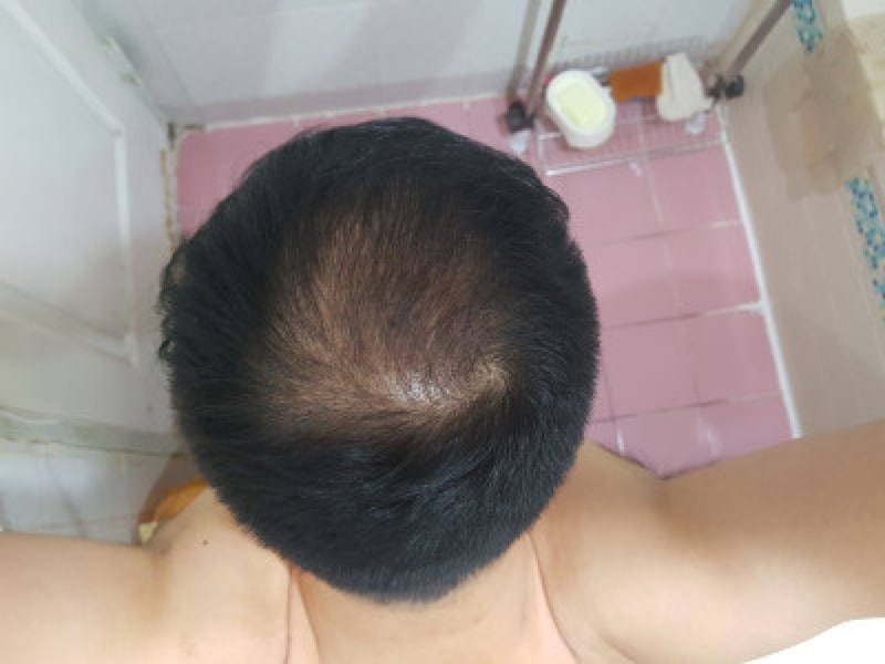 정수리 절개 이식 4천모 5개월 조금 넘은경과 보고 입니다.