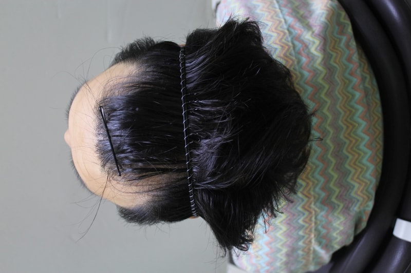 포헤어 수술 1년 경과 사진
