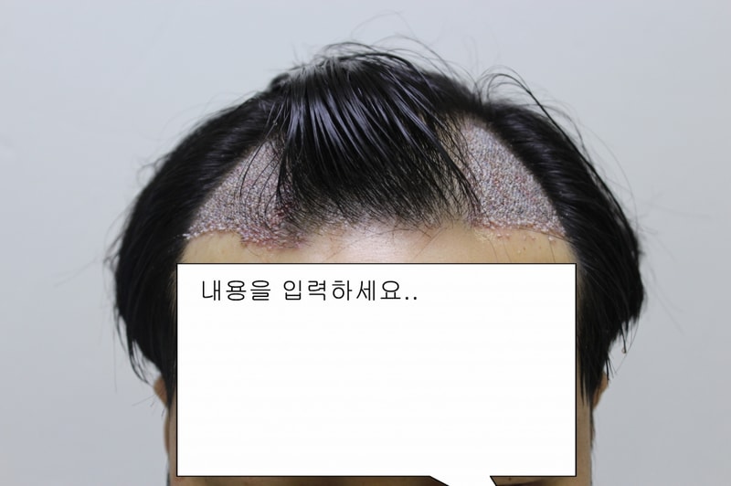 크기변환_수술직후.jpg