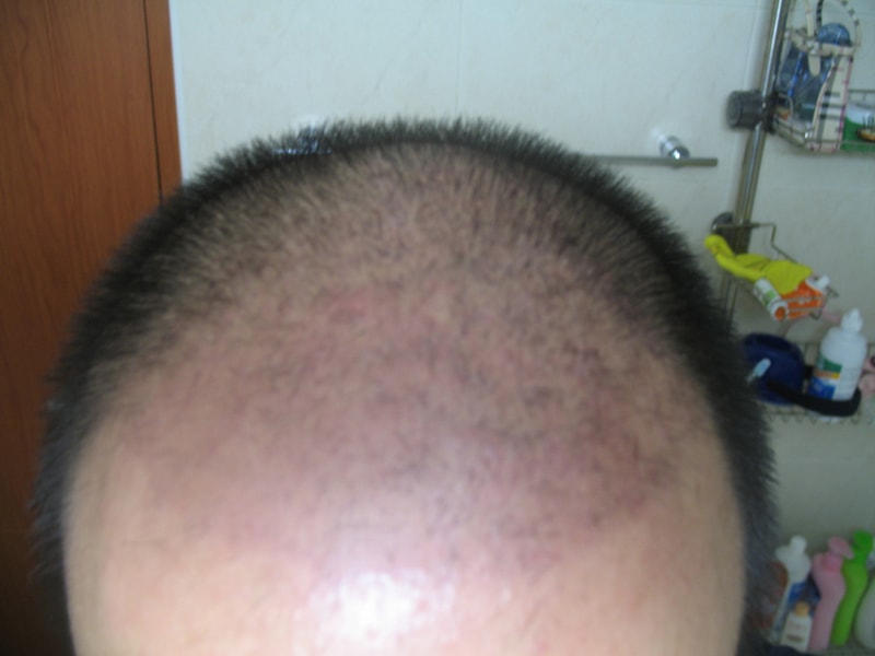 수술23일차-4.jpg