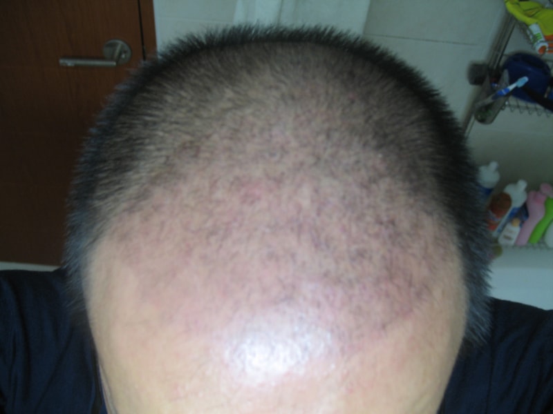 수술23일차-1.jpg