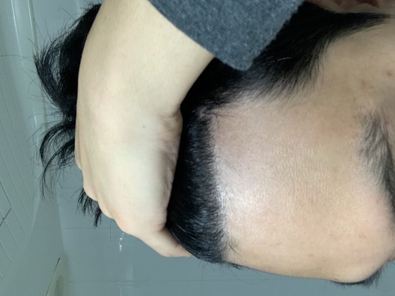 비절개 M자 3000모 이식 8달 경과입니다.