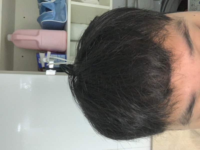 비절개 M자 3000모 이식 5달 경과입니다.