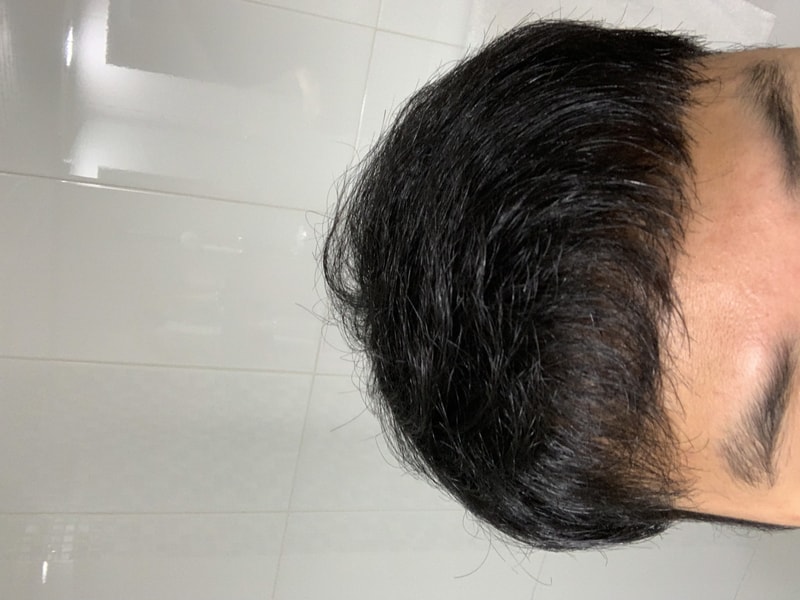 [모재성] 비절개 M자 3000모 이식 6달 경과입니다.