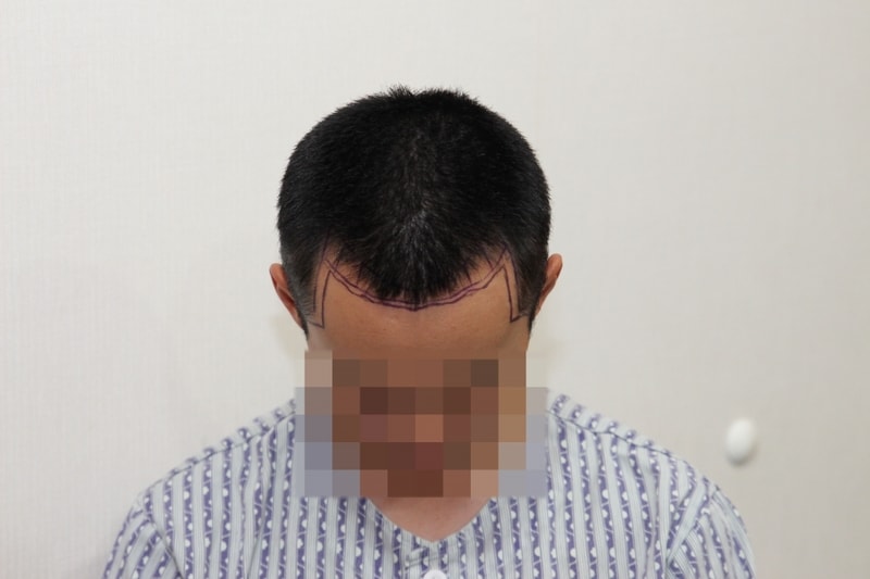 수술전3.jpg