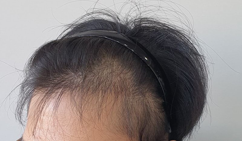 (1200th month) Review of hair transplantation for non-cut hair transplantation of hair follicles