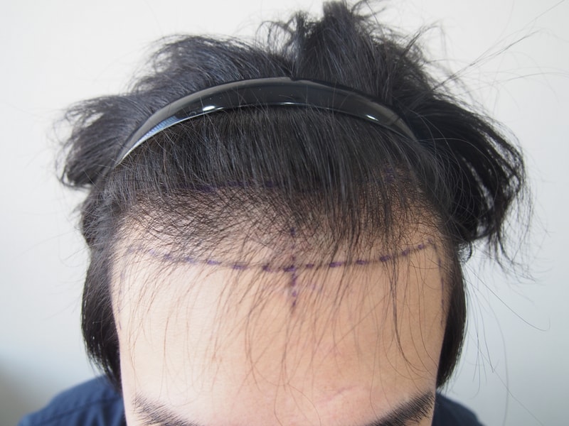 Late Day 1 of Parental 1600 Hair follicle Transplantation