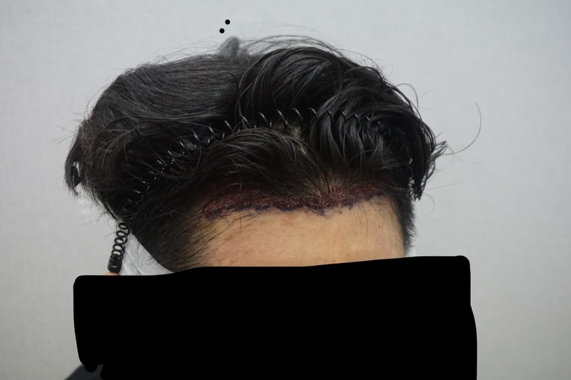 Morplus Plastic Surgery Department 2200 Mosseptomy 3 Months Later Dark Age