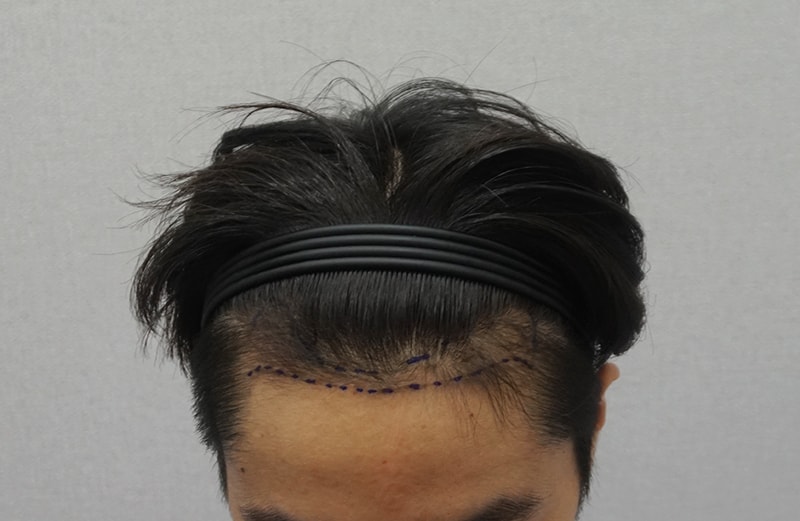 수술전디자인정면.jpg