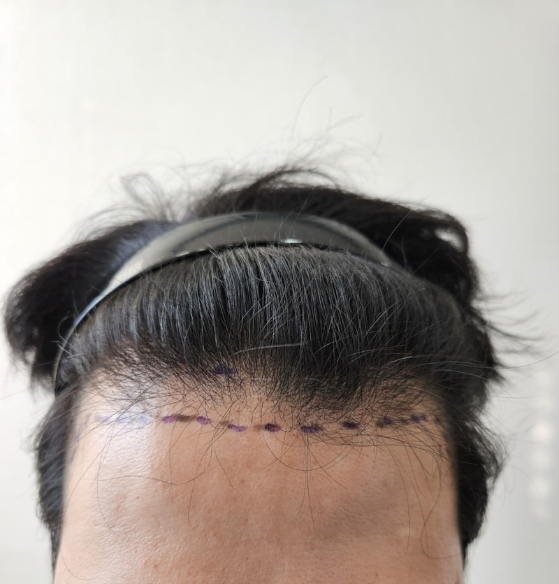 240507_모발이식 견적 디자인2_업로드.jpg